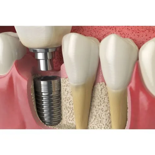 Dental Implants Diamond Creek